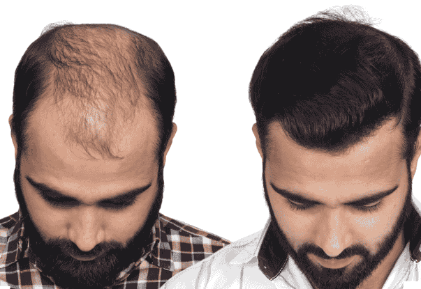 Hair transplant